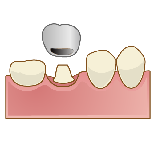 銀歯を装着するときのイメージ図