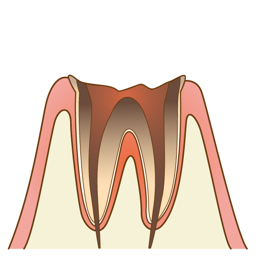 虫歯で歯茎より上の歯の大部分が失われ、神経を取った歯のイメージ