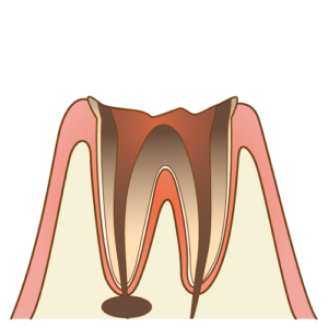 根の先に膿がたまった状態の歯のイメージ